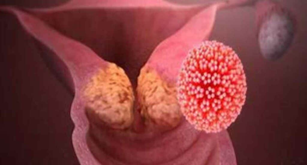 सर्वाइकल कैंसर(Cervical Cancer)