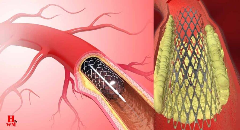 एंजियोप्लास्टी (Angioplasty) क्या है?